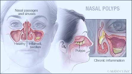 Mayo Clinic Q and A: Understanding nasal polyps - Mayo Clinic News Network